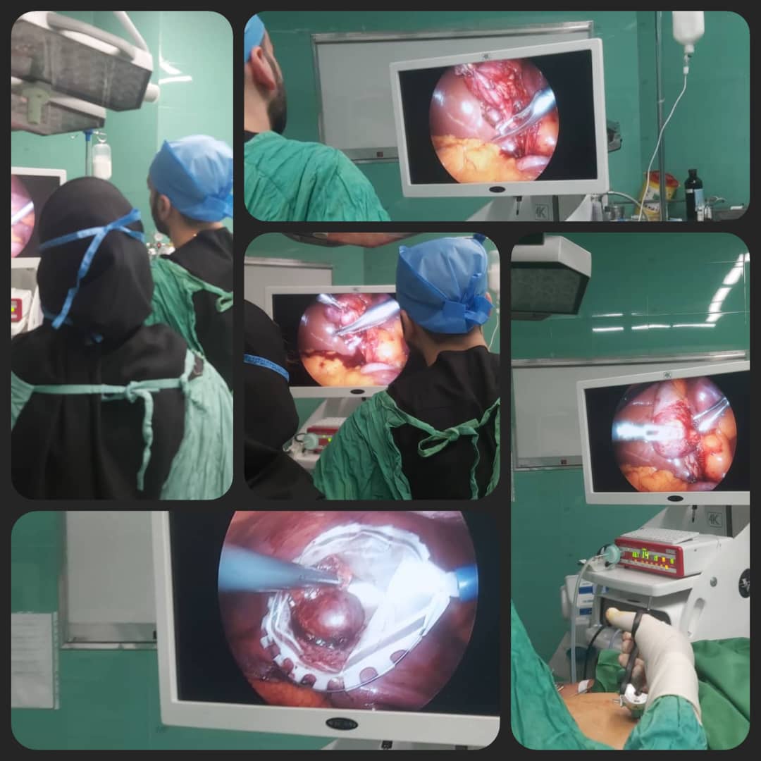 انجام موفقیت‌آمیز اولین عمل جراحی لاپاروسکوپیک کیسه صفرا در بیمارستان فاطمه الزهرا(س)